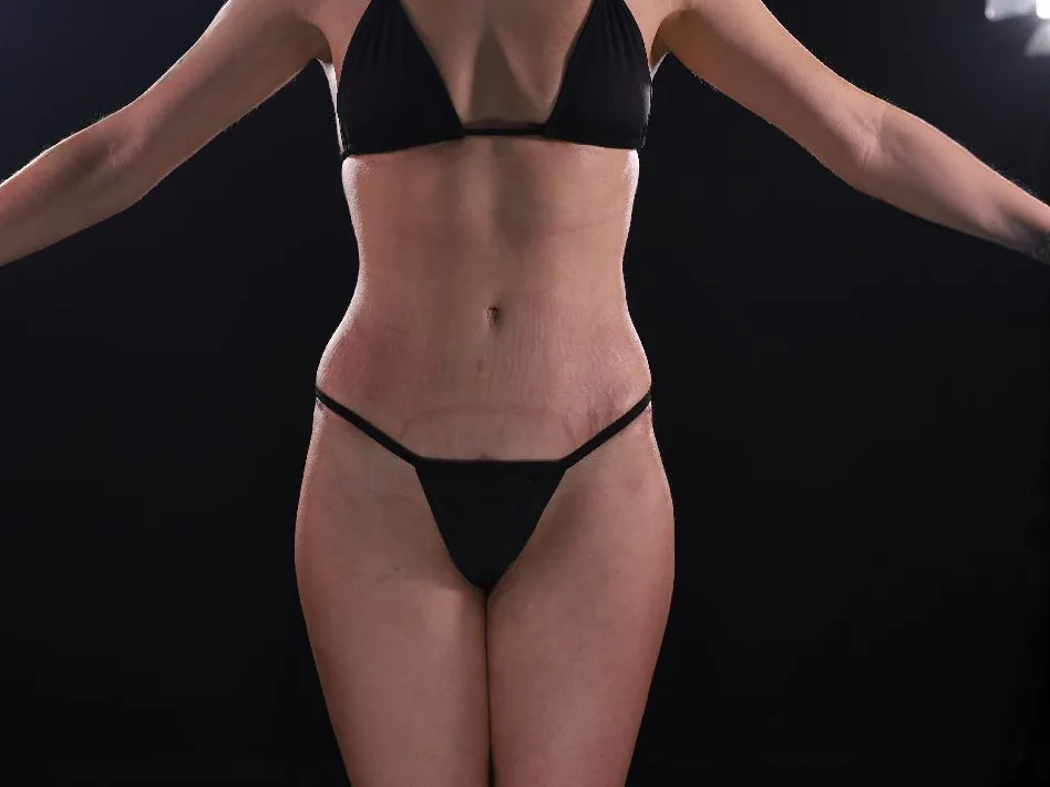 Abdominoplastia